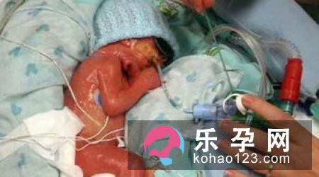 牙周炎成孕妈咪早产祸首