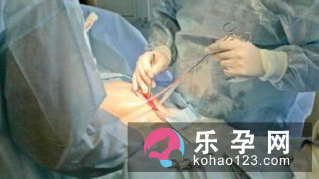 新生儿不经阴道挤压,不会遭遇难产危险