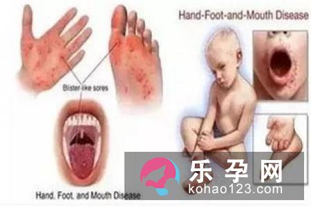小孩得了手足口病会传染给大人吗 传染期有多长