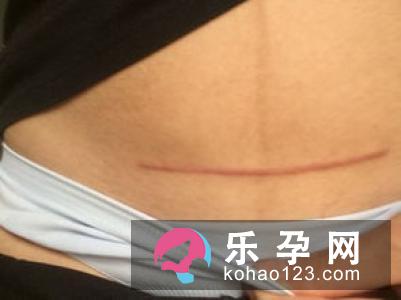 剖腹产疤痕增生怎么办 能去掉吗