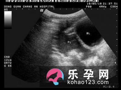 生产过快易造成胎儿肝脏破裂