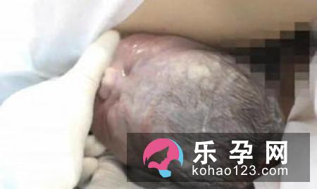自然分娩对产妇和胎儿都有好处
