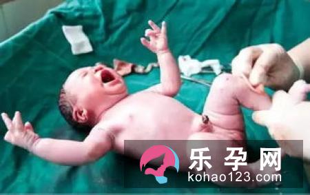 哪些产妇需要剖宫产