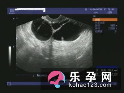 孕囊有积液怎么办 有回声和无回声是什么意思