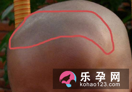 卤门闭合对宝宝有什么影响 怎么清洗