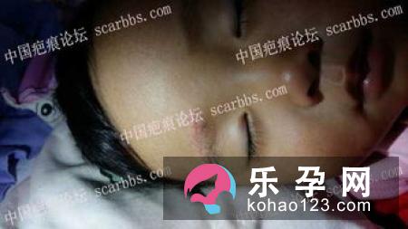 宝宝嘴巴磕破皮了肿了怎么办 多久能好