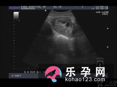 孕囊有积液怎么办 有回声和无回声是什么意思