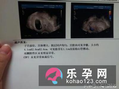 通过孕囊数据看生男生女大解析