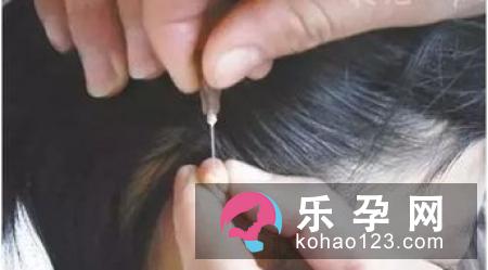 小孩发烧可以艾灸吗 艾灸什么穴位