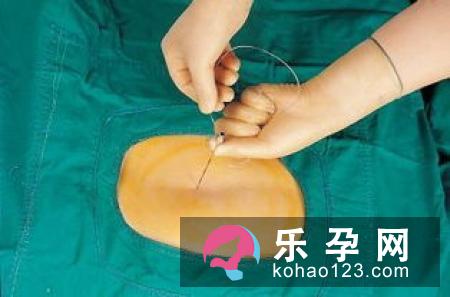 这些准妈不宜选无痛分娩