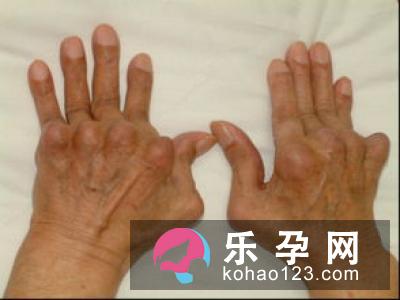 交叉腿综合症有危害吗 怎么治