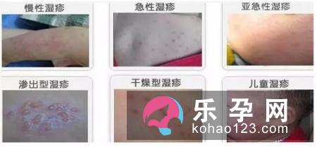 宝宝湿疹可以擦橄榄油吗 如何擦