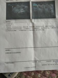 孕前检查为何一定要检查阴道炎