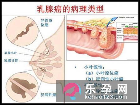 卤门是什么 有几种类型