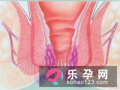 哺乳期产生痔疮的原因 能做痔疮手术吗 哺乳期产生痔疮的原因 能做痔疮手术吗
