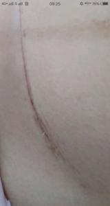 剖腹产线头多久吸收 不吸收怎么办 剖腹产线头多久吸收 不吸收怎么办