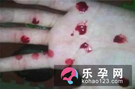 怀男孩鼻子会变大吗 孕妇流鼻血与胎儿性别有关吗