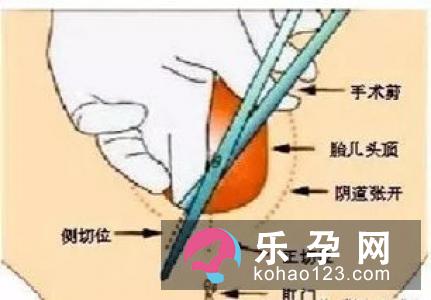 了解什么是侧切术