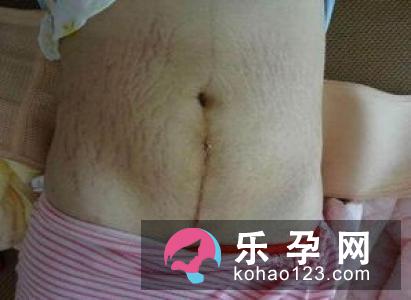 孕妈剖宫产 横切好还是竖切好