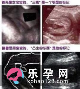 医学预测胎儿性别4方法