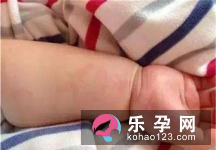 宝宝甲醛中毒的症状类型 会发烧吗