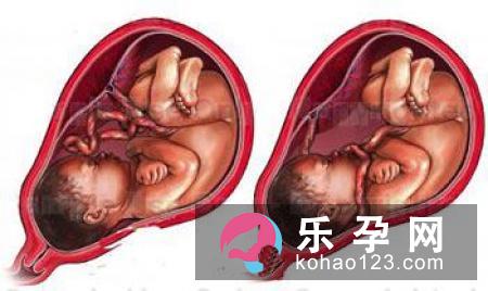 胎儿脐带绕颈是否要剖腹产