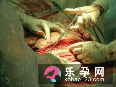 分娩时令人担心四个意外