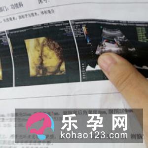 侧脑室增宽出生后影响孩子智力吗 出生后应该怎么做