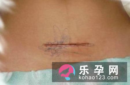 孕妈剖宫产 横切好还是竖切好